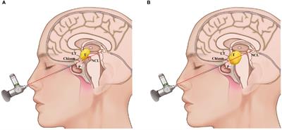 Expanded Transsphenoidal Trans-Lamina Terminalis Approach to Tumors Extending Into the Third Ventricle: Technique Notes and a Single Institute Experience